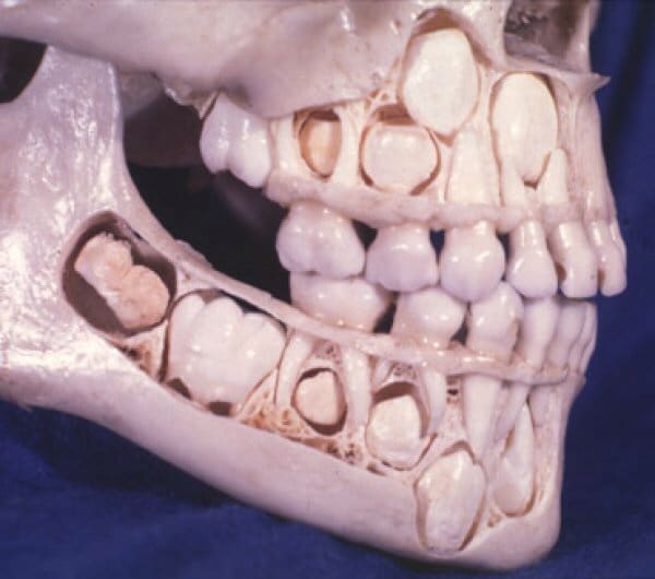 Child's skull with baby teeth intact